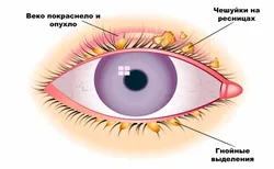 Воспалительные заболевания глаз - причины симптомы, диагностика и лечение