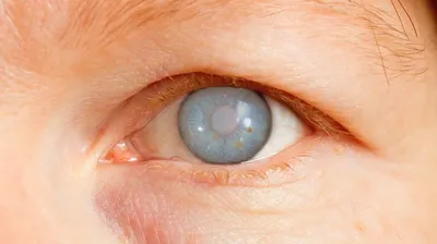 Лечение инфекционных и аллергических заболеваний глаз. Глазная клиника  «Мона Лиза».