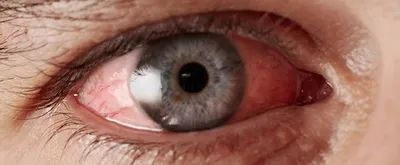 Воспаление глаза, покраснение и лечение
