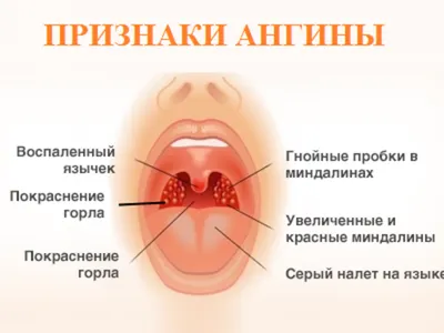 Фарингит: признаки, симптомы, лечение - МедКом