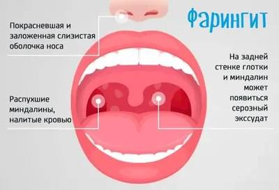 Инфекционные заболевания горла медицинский плакат A2+, плотная фотобумага  от 200г/м2 - купить с доставкой по выгодным ценам в интернет-магазине OZON  (262292595)