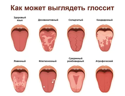 Глоссалгия [причины, симтомы, лечение]