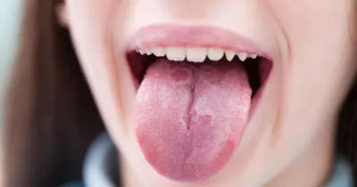 Болезни… языка! Что может вылечить стоматолог?