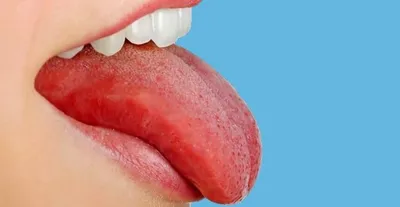 Лечение глоссалгии: боль и жжение языка — статьи «Зубная Формула»