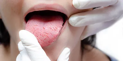 Болит корень языка: причины и методы лечения, диагностика, симптомы, как  предотвратить