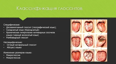 Аномалии и самостоятельные заболевания языка. Хронические рецидивирующие  трещины губ. Хейлиты - презентация онлайн