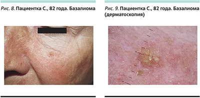 Заболевания кожи лица – аллергические, паразитарные, иммунологические,  бактериальные, вирусные, грибковые, сосудистые, онкологические