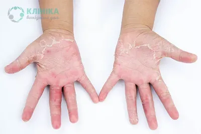 Заболевания кожи рук картинки