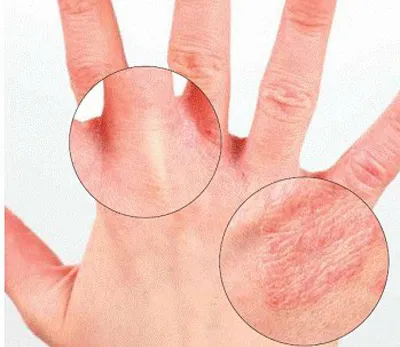 Заболевания кожи рук: аллергические, инфекционные и аутоиммунные -  Estet-Portal