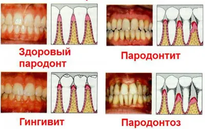 Полезные советы | Лечение полости рта, Полезные советы, Полости