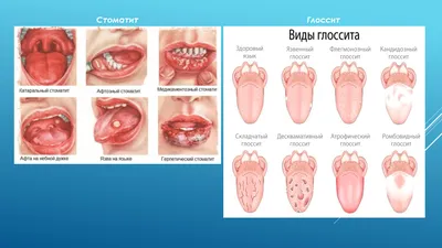 Посетите стоматолога, чтобы исключить онкологическое заболевания полости рта  | РКБ г. Реутов