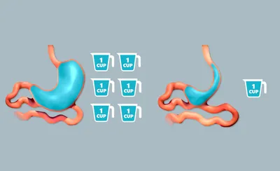 Размер желудка после резекции - Национальная бариатрическая практика