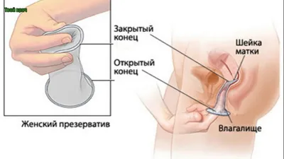 Негормональные средства контрацепции - от презерватива до губки