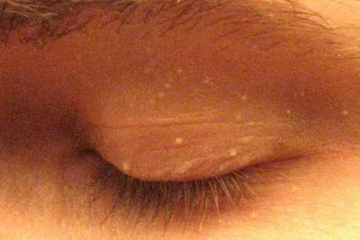 Лечение плоских бородавок на лице - Лазерсвiт