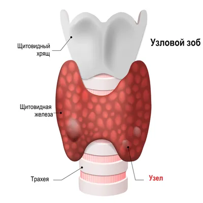 Тиреотоксикоз - причины появления, при каких заболеваниях возникает,  диагностика и способы лечения