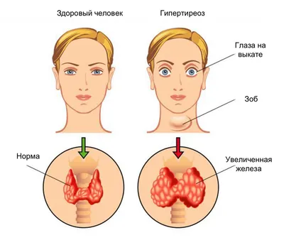 Диффузный зоб. Степени. Диагностика и лечение диффузного зоба в клиниках  НИАРМЕДИК