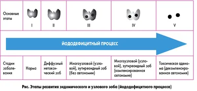 Семейная клиника "Здоровье" - ☝Эндемический зоб- это увеличение щитовидной  железы, связанное с дефицитом йода в воде и продуктах питания. ☝  Хроническая недостаточность микроэлемента запускает компенсаторные  механизмы в клетках. ☝Железа увеличивается ...