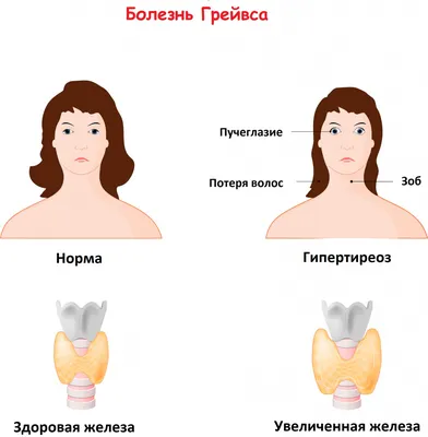 Диффузный токсический зоб - симптомы и лечение, причины возникновения и  профилактика базедовой болезни