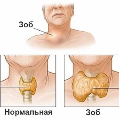 Лечение узлового зоба — (клиники Di Центр)