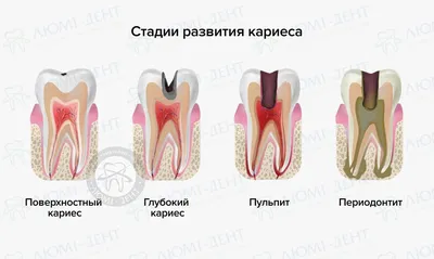 Зубная боль у ребенка - причины, чем снять, что делать, если болит зуб у  ребенка