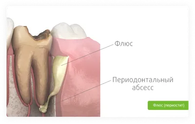 Болит зуб: причины и как лечить зубную боль - Клиника Лукашука