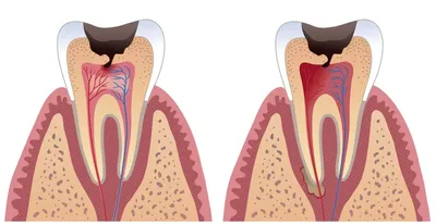 Болит зуб после лечения пульпита - почему болит?