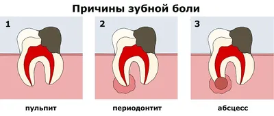 Как возникает сильная зубная боль - Быстро избавиться от зубной боли
