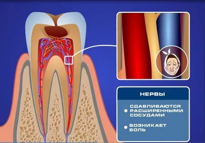 Острая боль в зубах | Что делать когда болит зуб? — 