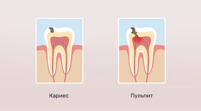 Зубная боль. Как дожить до рассвета? – Стамил