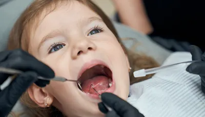 Лечение кариеса молочных зубов у детей в Профессорской стоматологии на  Арбате