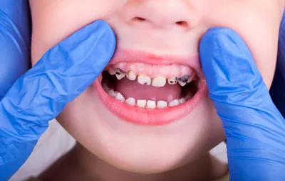 Когда следует удалять молочные зубы | NeoLifeDental