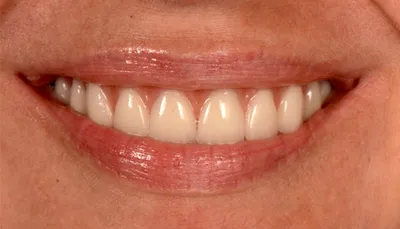 Белоснежные зубы – реализация мечты при помощи белых керамических коронок и  виниров
